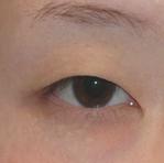 双眼皮手术案例 我也是大眼美女啦
