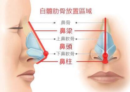 自体肋软骨隆鼻变形弯曲后常见的修复方法