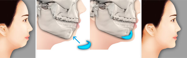 硅胶假体隆下巴会导致原下巴变形吗