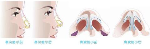 鼻孔缩小手术后的护理怎么做