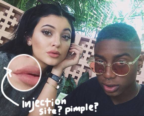 kylie-jenner-lip-injection-main__oPt