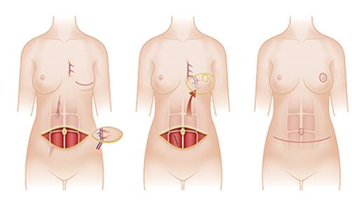乳房再造手术后能不能马上植入假体材料