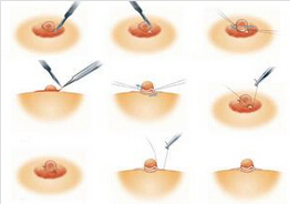 乳头缩小的手术方法有哪些