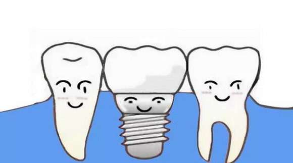 牙齿缺失后能做种植牙齿吗