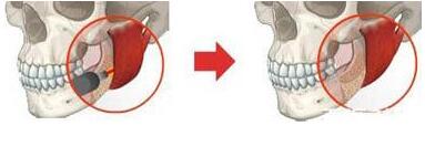 做下颌角磨骨后多久能见效