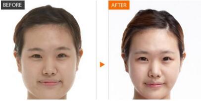 什么脸型需要做颧骨手术 需要多长时间恢复