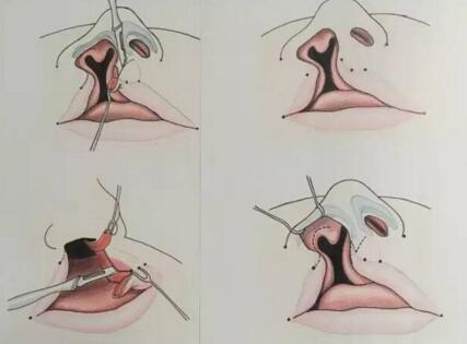唇裂产生的原因 唇裂修复是怎么手术的