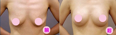乳房下垂矫正案例