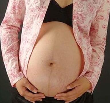 妊娠纹可以用激光去除吗