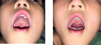 唇裂修复整形的麻醉方法 给孩子一个快乐的童年