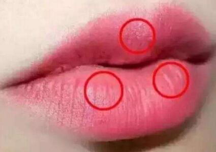 <font color=red>注射丰唇</font>增厚你的薄唇 使女人增更具性感