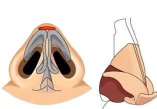 鼻小柱支撑物在鼻尖整形中的作用
