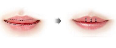 厚唇修薄手术过程 为面部增添美感