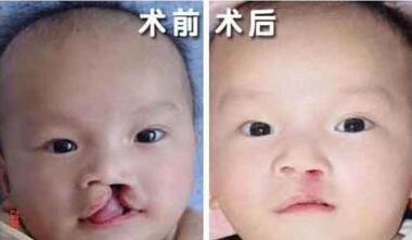 唇裂修复的手术步骤 还孩子健康容颜