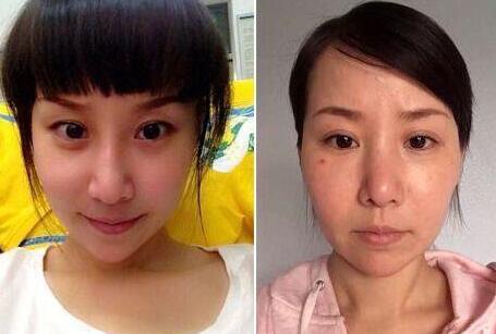 中国女孩花费7万元赴韩国整容，整容失败后变成“马脸”