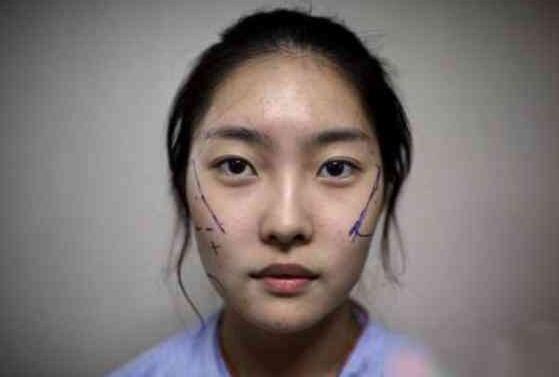 韩国女大学生整容过程 下巴进行“改造”