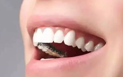 广州南方燕岭牙齿矫正效果如何