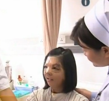 中国式换脸术 5岁时火场重度烧伤面部全非