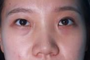 莆田少珍医疗做双眼综合+鼻综合隆鼻 效果现在越来越自然了