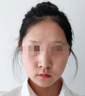 从九江汪海峰医疗做完自体软骨隆鼻 五官的感觉都不一样了