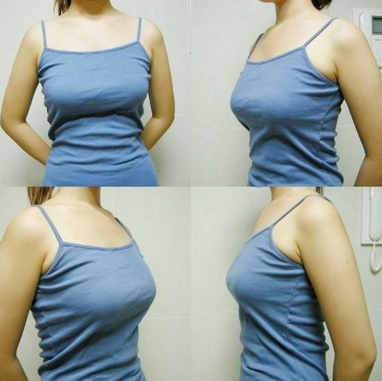 自体脂肪丰胸让女性更加的性感