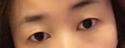 佳木斯妇幼医疗整形科韩式双眼皮 让眼皮不再无精打采