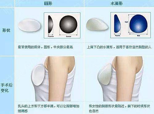北京同仁医院整形美容科隆胸失败修复的过程
