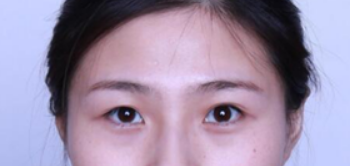 贺州人民医院美容整形科做了双眼皮开眼角 现在眼睛真好看