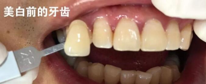 漯河第二人民医院医疗整形科牙齿美白 大白牙不再是梦想