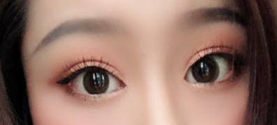 在深圳北大医院整形外科做双眼皮综合术 双眼放大靓丽可人