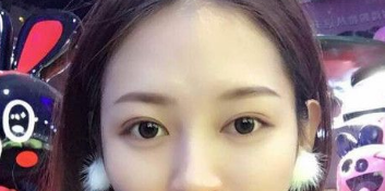 上海万众医院整形科做了眼部修复 挽回了我的好颜面