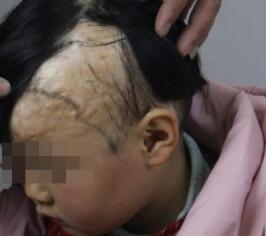 武汉第三医院美容整形科植发 让头顶不再凉飕飕