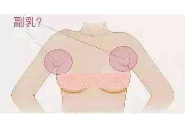 副乳切除有哪些优势呢  让你重拾性感迷人乳房