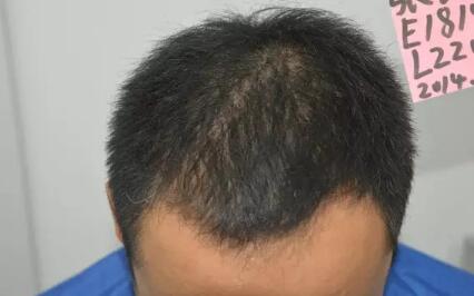 头发种植后额头肿是怎么回事  植发效果多久能看到