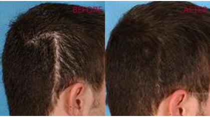 疤痕植发手术的特点有哪些  植发有没有年龄限制