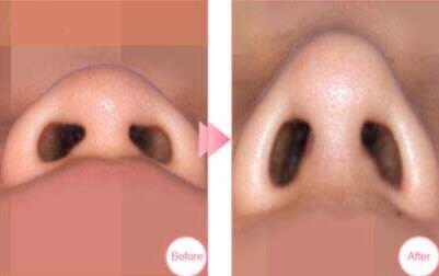 鼻尖整形可以用假体吗  量身定制高挺翘鼻