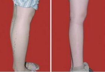 肉毒素瘦腿有哪些优点呢  让你拥有完美腿型超短裙随便穿