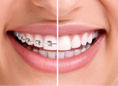 成人牙齿矫正的适应症有哪些 知错就改 善莫大焉