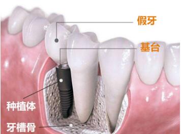 牙齿修复的材料有哪些呢  种植牙的效果怎么样