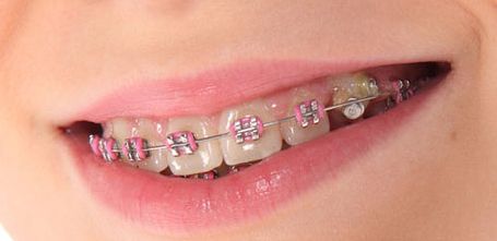 传统牙齿矫正的优势有哪些呢 传统牙齿矫正存在什么缺点呢