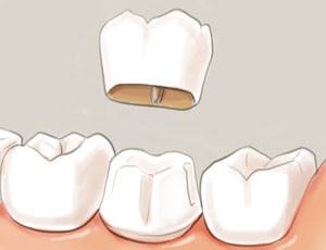 牙冠修复的好处有哪些呢 牙冠修复的适应人群有哪些呢