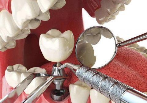 种植牙术后并发症有哪些呢 术后出现牙龈出现白点怎么办