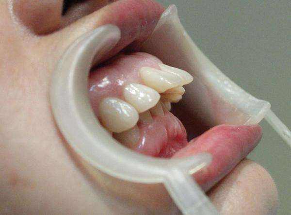 骨性龅牙的治疗过程怎么样呢 适应症有哪些呢