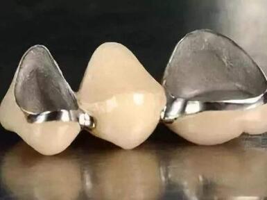 全瓷牙和烤瓷牙有什么区别呢  烤瓷牙有哪些优势