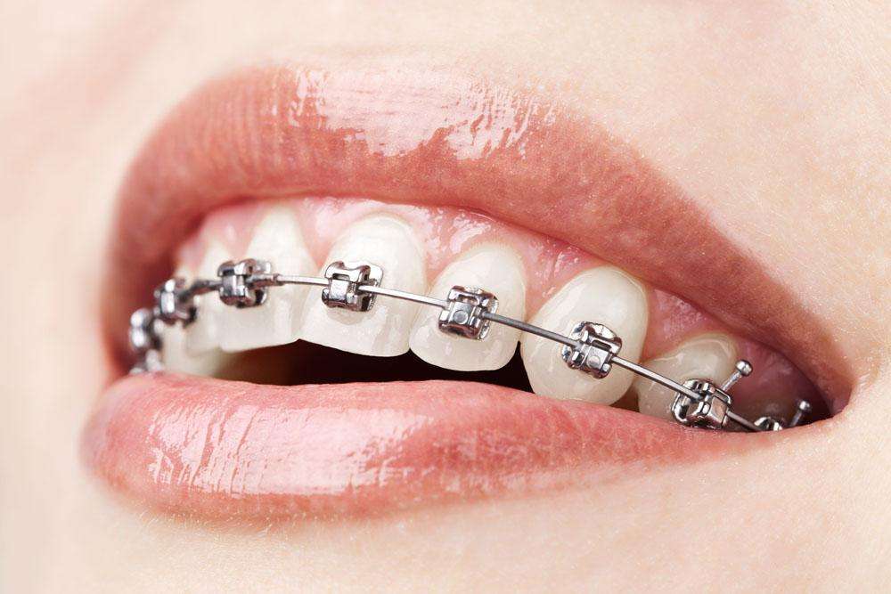 牙齿正畸对脸型的影响有哪些呢 正畸价格怎么样呢