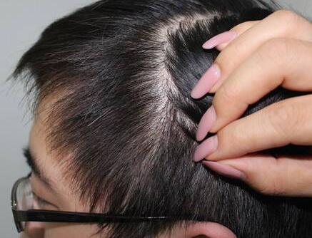 男人秃头是什么原因 南京疤痕植发医院哪家比较好