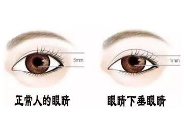 北京美颐天整形医院上眼脸下垂手术优势有哪些  方法有哪些