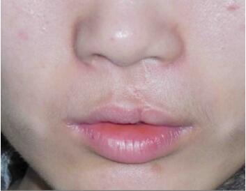 重庆惠美整形医院唇裂修复的优势有哪些  手术安全吗