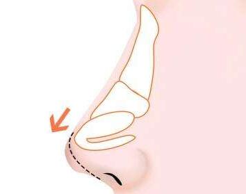 丹东王大夫整形医院歪鼻矫正的优点  有哪些适应症