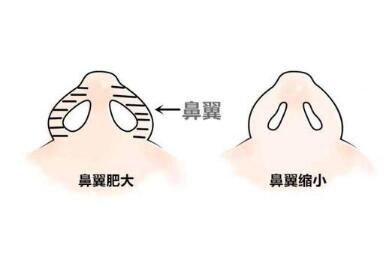 天津第三中心医院整形科鼻翼缩小术的优势有哪些呢